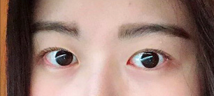 dark circle removal in korea made young